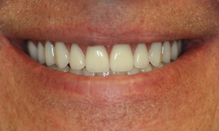Complete-Denture-Upper-and-Lower-After-Image