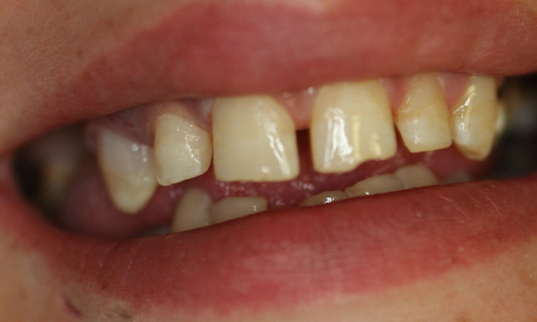 Dental-Bonding-After-Image
