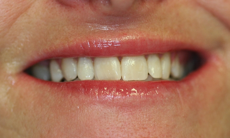 Six-Month-Smiles-After-Image