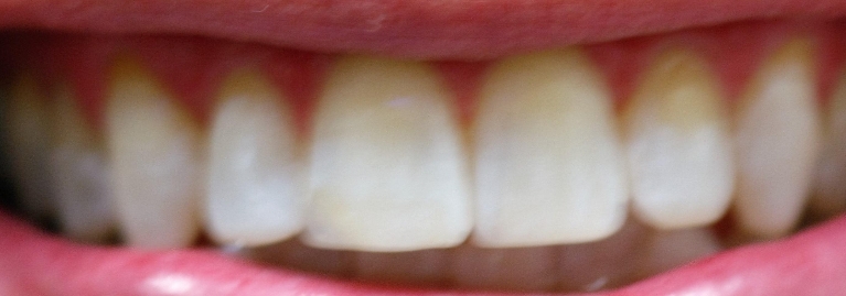 Teeth-Whitening-After-Image