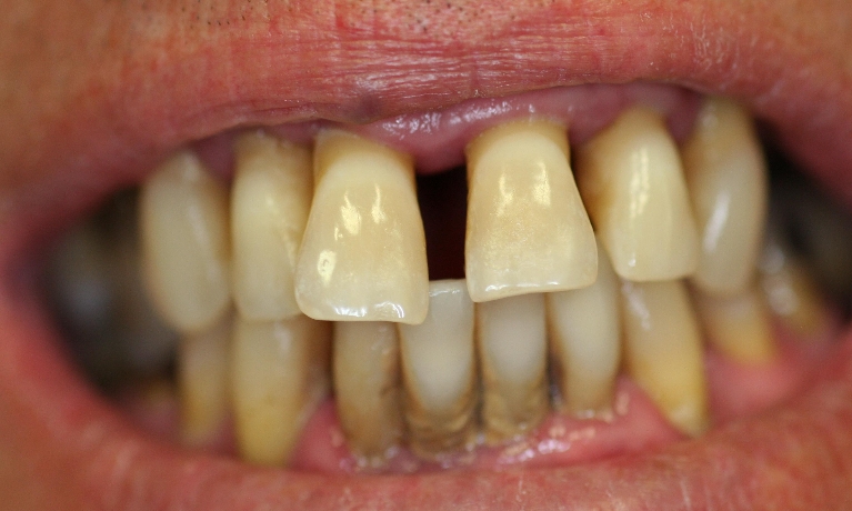 Complete-Denture-Upper-and-Lower-Before-Image