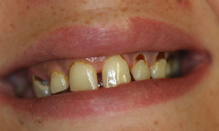 Dental-Bonding-Before-Image