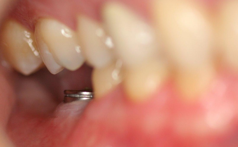 Dental-Implant-Before-Image