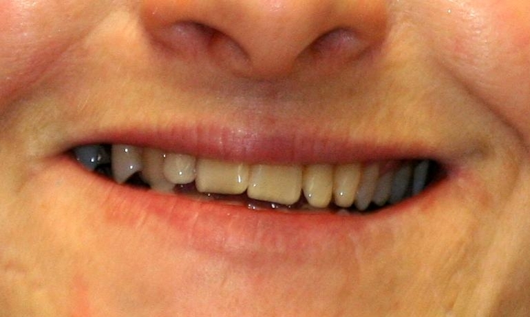 Six-Month-Smiles-Before-Image